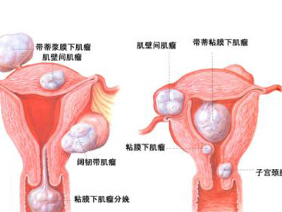 子宮肌瘤可分為什么種類(lèi)