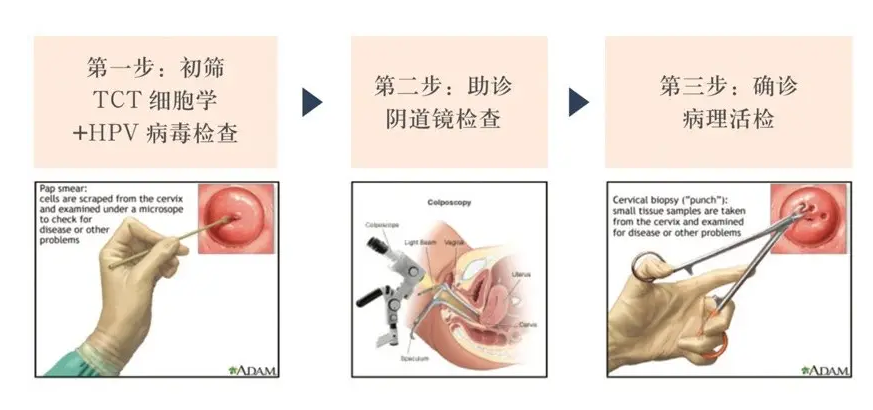 什么情況下需要宮頸活檢？一文說清宮頸活檢的意義