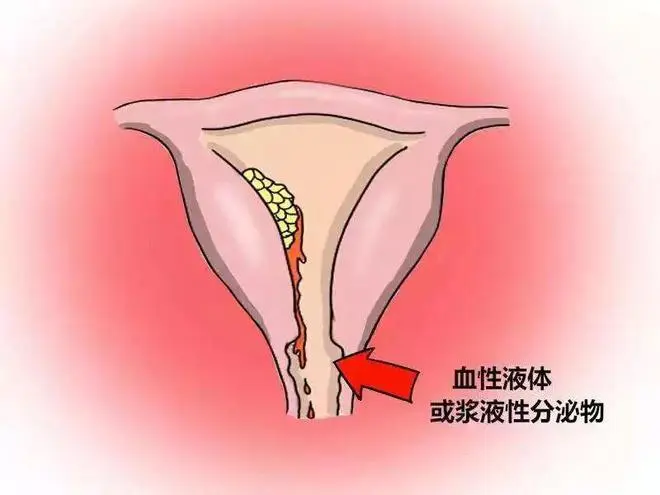 女性非經(jīng)期出血，可能是什么原因？